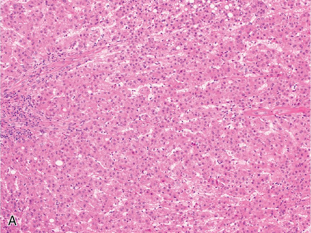 Fig. 4.8, Hepatocellular carcinoma (HCC). The most common architectural patterns in HCC are trabecular (A) and pseudoglandular (B) , which are often intermixed. Trabeculae thickness averages to 3–6 cells wide, and pseudoglands may contain either bile plugs or debris.