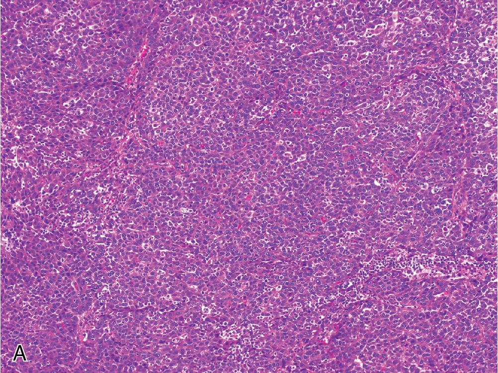 Fig. 4.9, Hepatocellular carcinoma. Several architectural patterns have been correlated with more aggressive tumor behavior. A, The solid pattern is characterized by sheets of hepatocytes with obliteration of the normal sinusoidal spaces. B, Macrotrabecular architecture is defined by widened trabeculae that average more than 6 cells across.