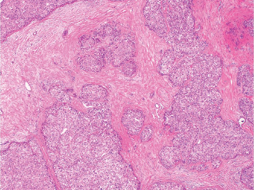 Fig. 4.10, The scirrhous variant of hepatocellular carcinoma shows infiltrative tumor nests separated by abundant fibrous stroma.