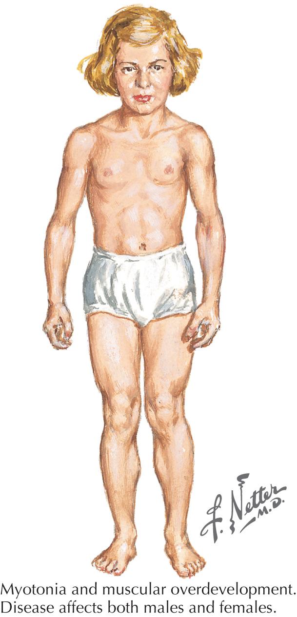 Fig. 70.1, Myotonia Congenita (Thomsen Disease).