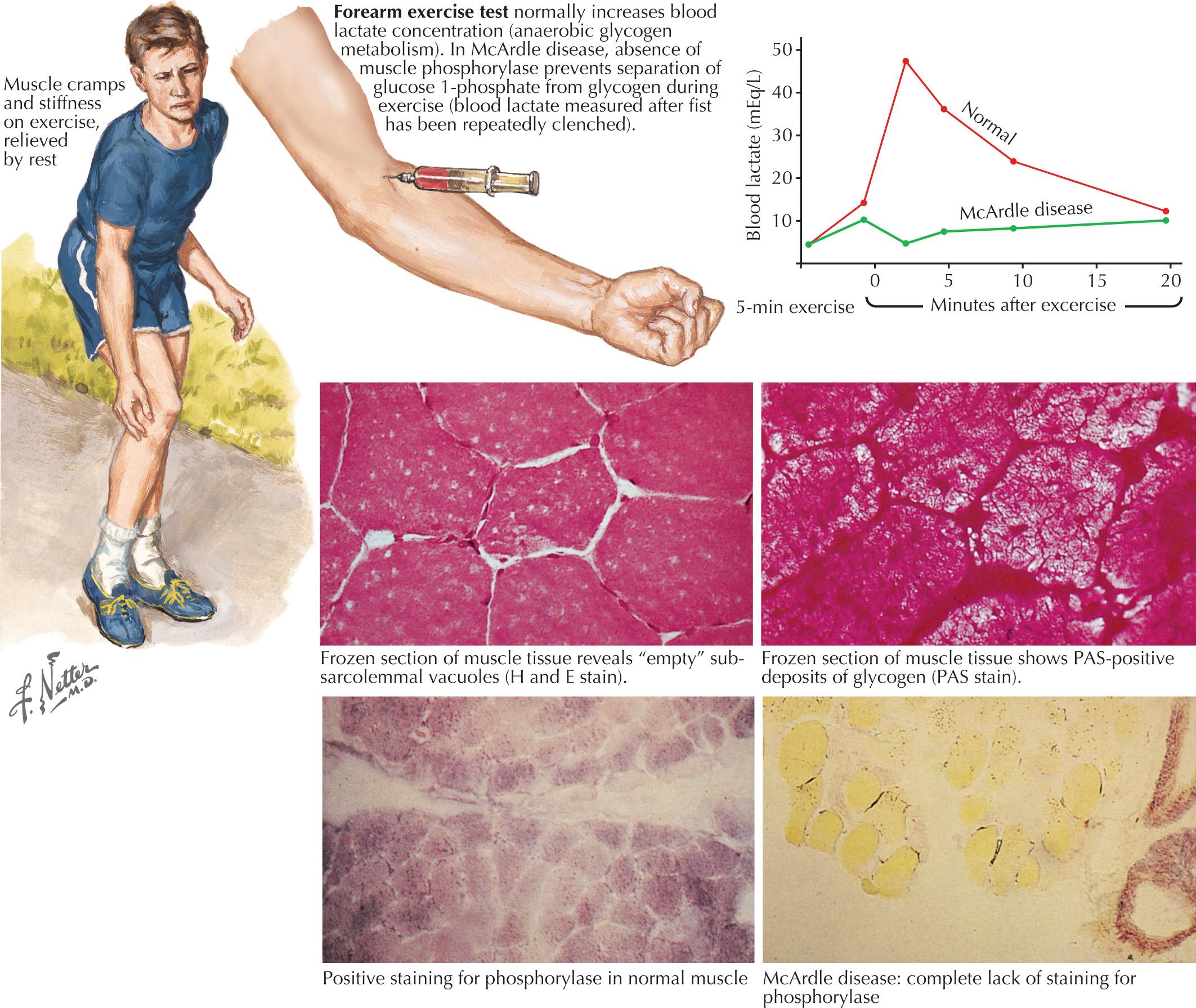 Fig. 70.2, McArdle Disease.