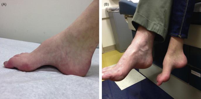 Figure 17.4, ( A ) High arches (pes cavus) and hammertoes in a 14-year-old female with CMT1. Patient walked before the age of 15 months. Nerve conduction velocities in the upper limbs ranged from 12.7 to 23.7 m/s and in the lower limbs from 10.3 to 15.4 m/s. Sensory nerve action potentials could not be elicited in the median, ulnar, sural, or superficial peroneal nerves. ( B ) Patient's father also has pes cavus but of milder severity. Multiple members on father's side of the family, including his mother, are affected by CMT with definite male-to-male transmission in the pedigree. Patient in ( A ) is currently being tested for the PMP22 duplication (CMT1A). If this testing is negative, she will be tested for CMT1B ( MPZ ).