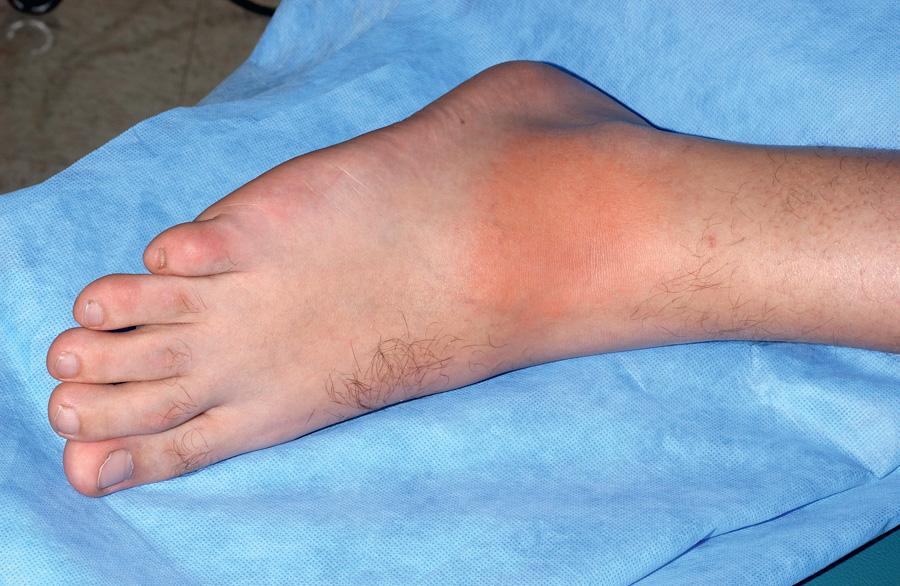 Fig. 188.2, Characteristic erysipeloid erythema associated with familial Mediterranean fever.