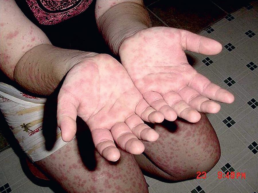 Fig. 188.3, Polymorphic rash on the hands, arms, and legs of a patient with hyper-IgD syndrome (HIDS).