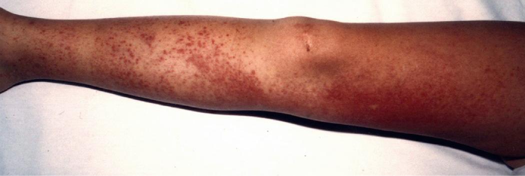 Fig. 188.4, Petechiae on the leg of a hyper-IgD syndrome patient during a febrile attack.