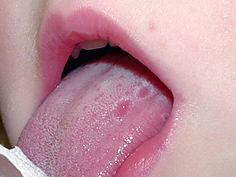 Fig. 188.5, Aphthous ulceration detected on the tongue of a patient with hyper-IgD syndrome.