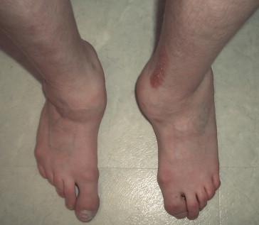 Figure 18.1, Orthopedic sequelae in HSAN type II. Repeated multiple fractures of weight bearing joints have resulted in bilateral Charcot joints of ankles.