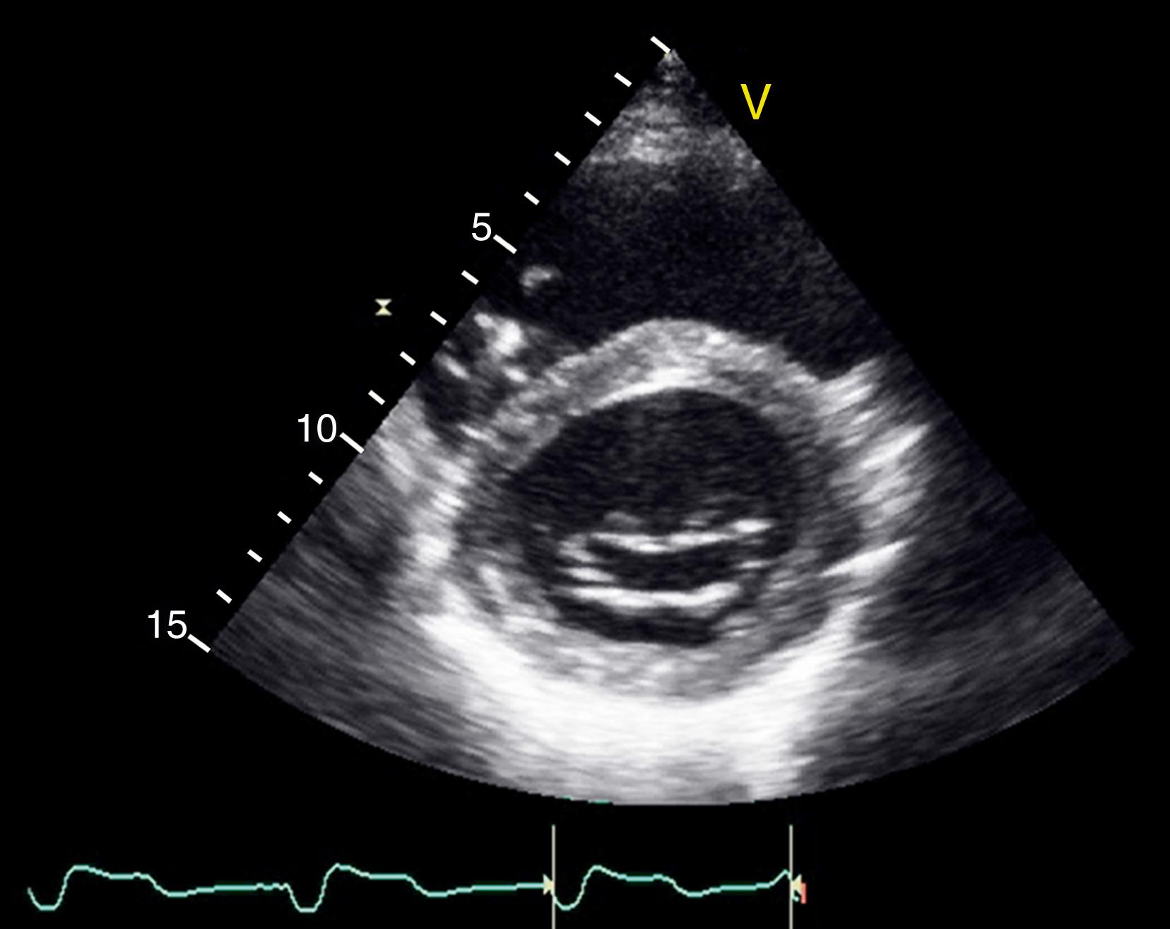 Figure 71.2, Basal short-axis view of the left ventricle demonstrating speckling of the myocardium in the inferior wall and anterior septum in contrast to the normal appearance of the anterior wall.