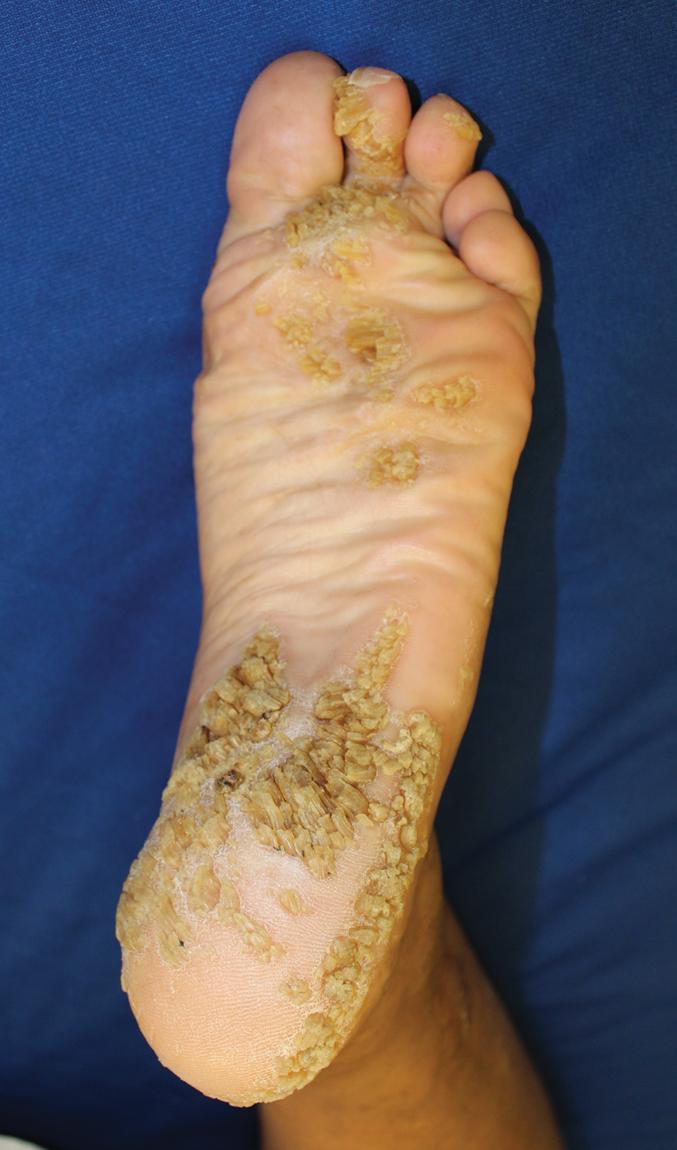 Fig. 5.11, Ichthyosis hystrix. Verrucous plaques on the plantar surface. This girl had undergone grafting of the palms to increase hand function.