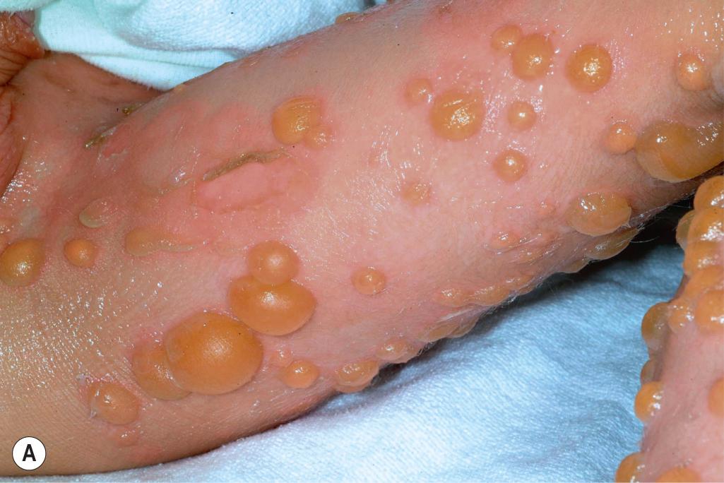 Fig. 5.12, Superficial epidermolytic ichthyosis. (A) Occasionally, affected individuals may show tense bullae that resemble bullous pemphigoid (see Chapter 13 ). The bullae on this patient arose when he developed a viral exanthema. (B) More typically, there is mild kyperkeratosis and a “molting” appearance with desquamation of superficial scale.