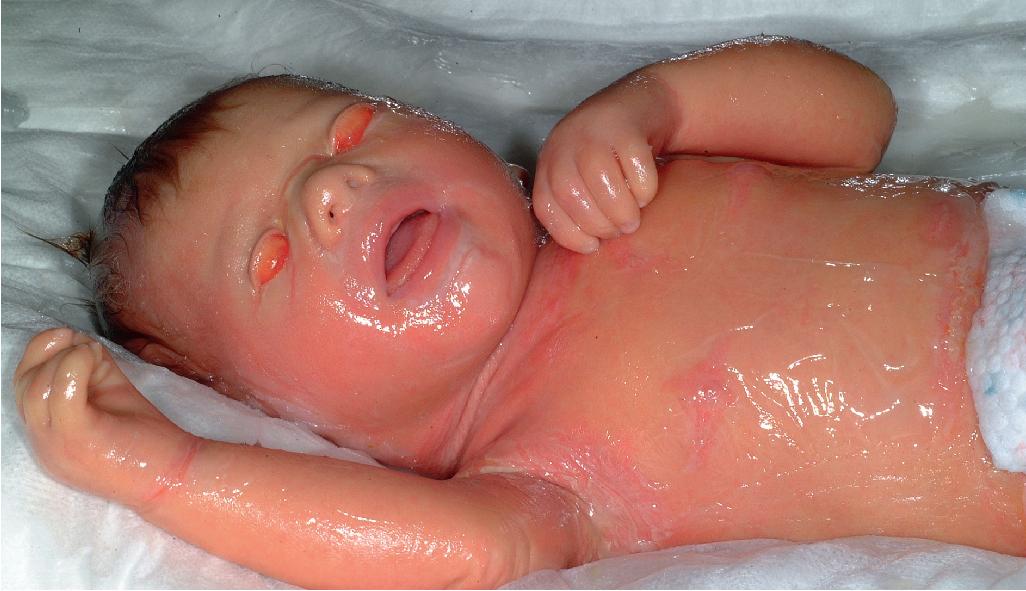 Fig. 5.14, Collodion baby. Note the shiny thickened skin, mild ectropion, mild eclabium, and ear deformity. In this 5-day-old baby, the “membrane” is starting to crack and desquamate.