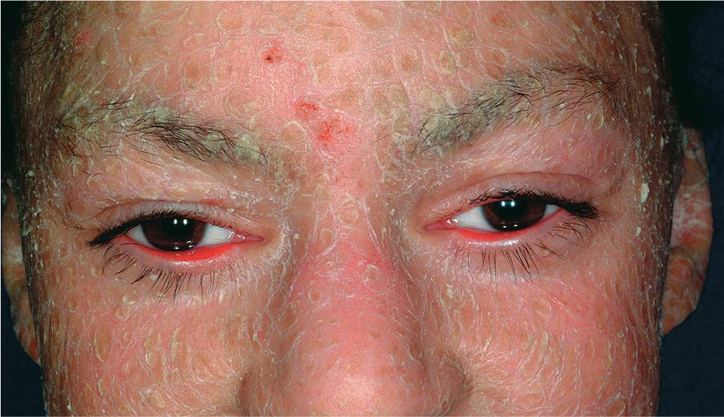 Fig. 5.15, Lamellar ichthyosis. Lamellar ichthyosis phenotype of autosomal recessive congenital ichthyosis (ARCI). Large plate-like scaling on the forehead and cheeks. This patient shows moderate ectropion.