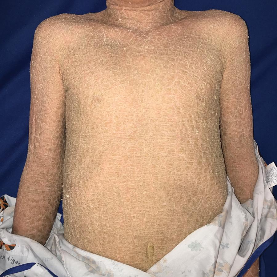 Fig. 5.16, Lamellar ichthyosis. Lamellar ichthyosis phenotype of autosomal recessive congenital ichthyosis (ARCI). Large plate-like scaling on the trunk and arms.