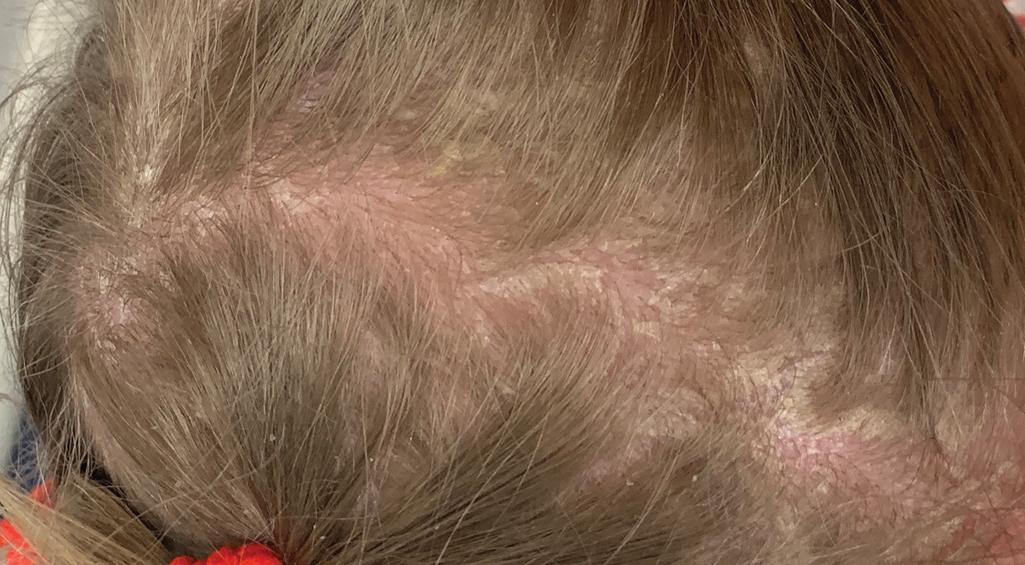 Fig. 5.17, Lamellar ichthyosis. Thick scaling on the scalp. This girl has minimal alopecia, but some have severe alopecia that becomes cicatricial.