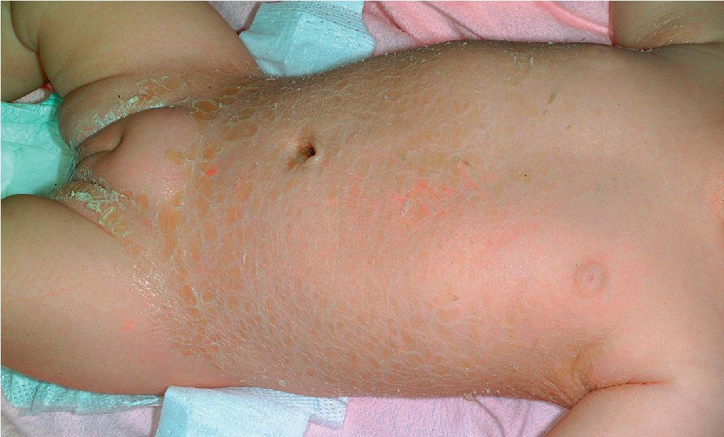 Fig. 5.18, Lamellar ichthyosis, temperature sensitive. Bathing suit distribution, lamellar ichthyosis phenotype of autosomal recessive congenital ichthyosis (ARCI). This distribution of the ichthyosis, largely involving the trunk and intertriginous areas with sparing of the face and limbs, signals a temperature-sensitive mutation in TGM1, encoding transglutaminase 1. This baby was born with a full collodion membrane.