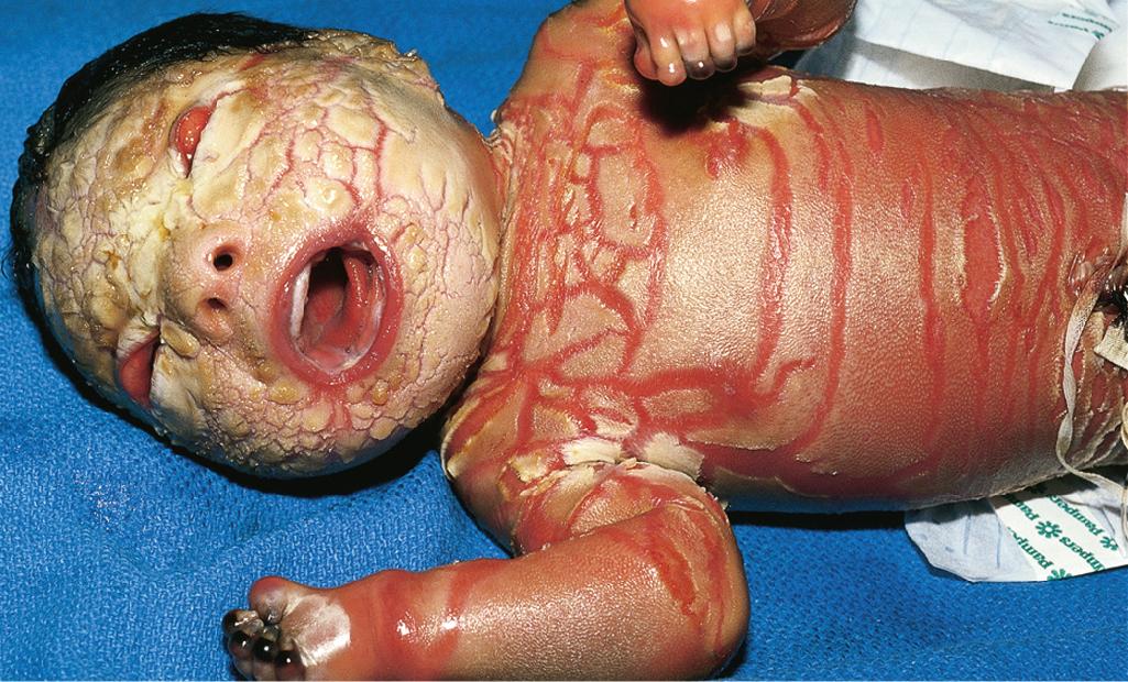 Fig. 5.21, Harlequin ichthyosis. Profoundly thickened, armor-like skin with fissuring, leading to the polygonal, triangular, or diamond-shaped plaques that simulate the costume of a harlequin. Note the severe ectropion, eclabium, and digital infarction.