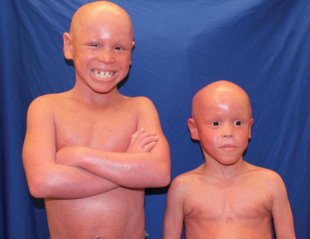 Fig. 5.22, Harlequin ichthyosis. These two brothers with ABCA12 variants survived the neonatal period without retinoid intervention. With application of moisturizer multiple times daily, they are thriving, but have recurrent methicillin-resistant Staphylococcus aureus (MRSA) infections, and one suffers from early-onset synovitis. Note the severe erythroderma and total alopecia.