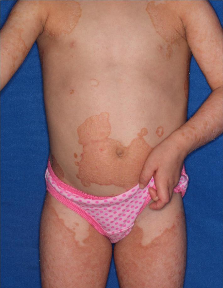 Fig. 5.23, Erythrokeratodermia variabilis (EKV). This girl shows well-demarcated plaques that sometimes are migratory.