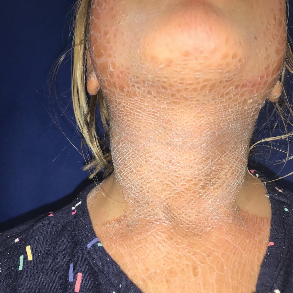 Fig. 5.24, Erythrokeratoderma variabilis (EKV). This girl shows fixed, well-demarcated plaques. Note the symmetric sparing on the clavicular areas.