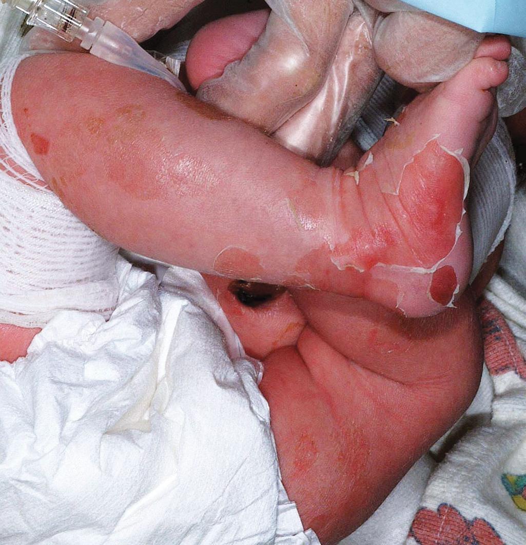 Fig. 5.6, Epidermolytic ichthyosis. In the neonate, superficial blisters predominate and may be mistaken for epidermolysis bullosa.