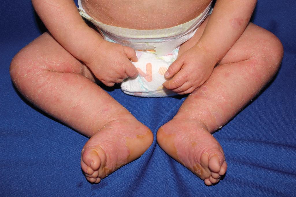 Fig. 5.7, Epidermolytic ichthyosis. Within the first several months, blistering tends to be reduced, but scaling becomes apparent, as seen in this 8-month-old with a variant in KRT10 .