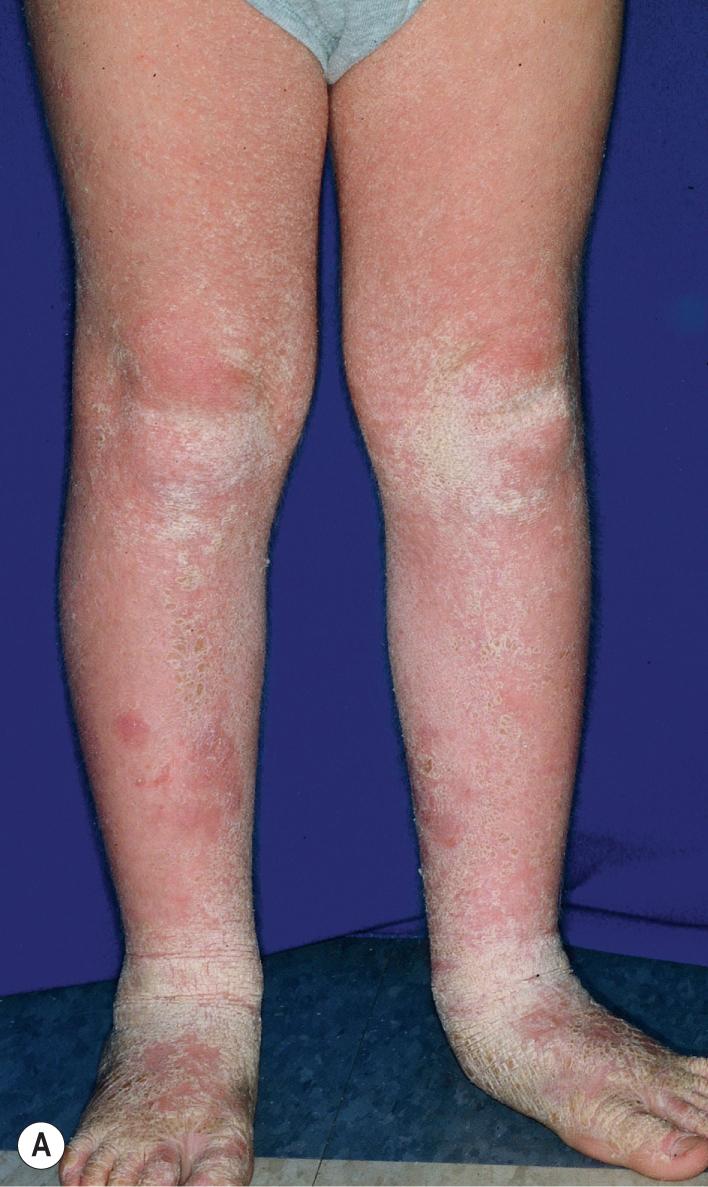 Fig. 5.8, Epidermolytic ichthyosis. (A) Thick verrucous scale on the legs of a 6-year-old boy. Note the intensification of scaling over the knees and ankles and the areas of blistering on the legs. (B) The scaling can take on a corrugated appearance.