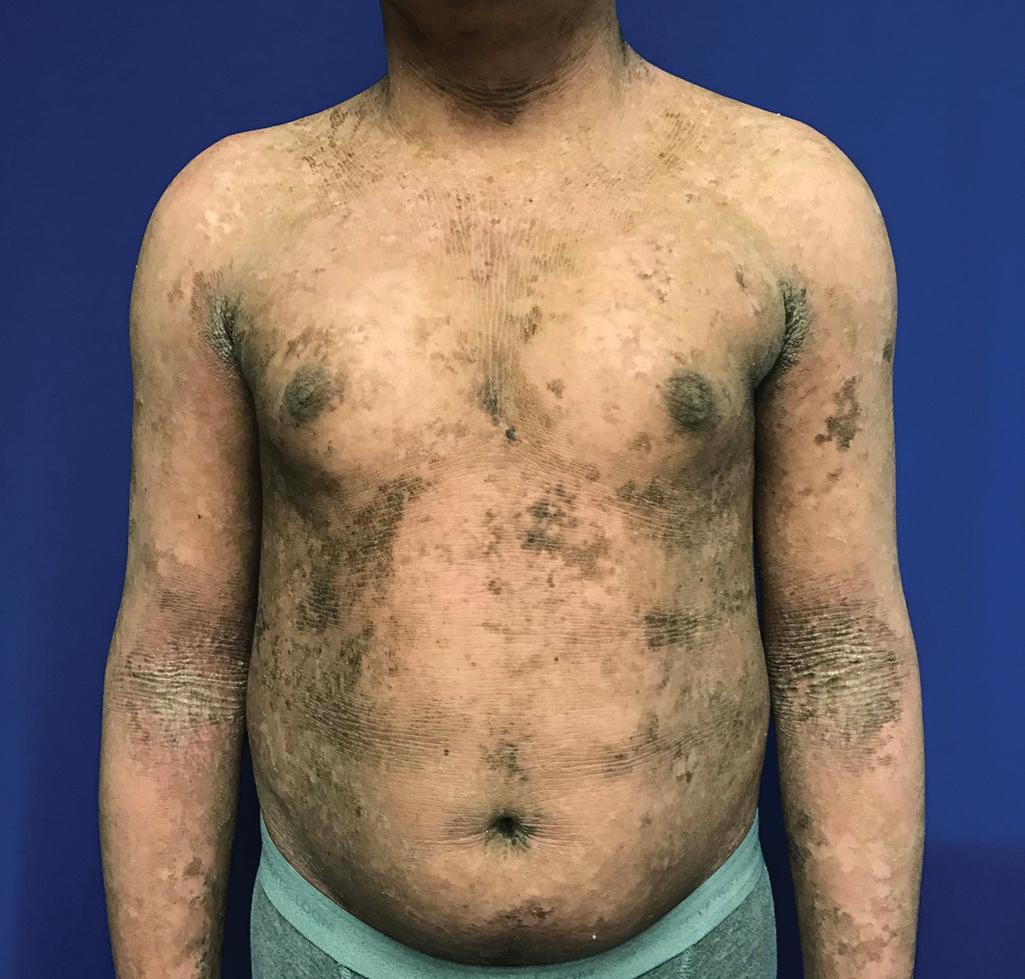 Fig. 5.9, Extensive corrugated scale of epidermolytic ichthyosis with accentuation in the fold areas.