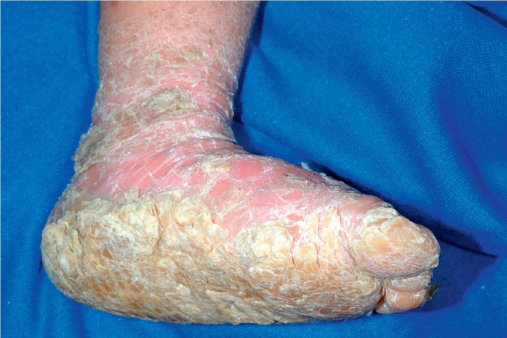 Fig. 5.10, Epidermolytic ichthyosis. The marked hyperkeratotic sole in this child virtually ensures that the underlying gene defect involves KRT1 .