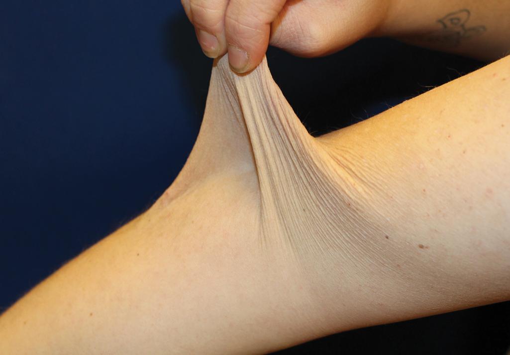 Fig. 6.1, Ehlers–Danlos syndrome. Skin hyperextensibility on the arm.