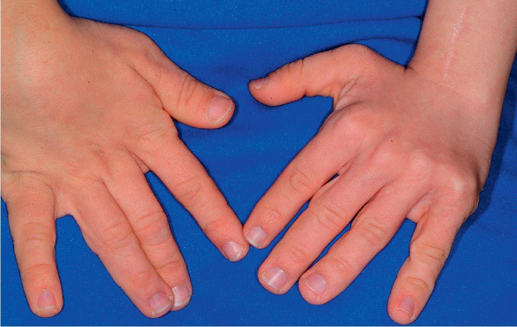 Fig. 6.11, Costello syndrome. Note the loose, hyperextensible skin of the digits.