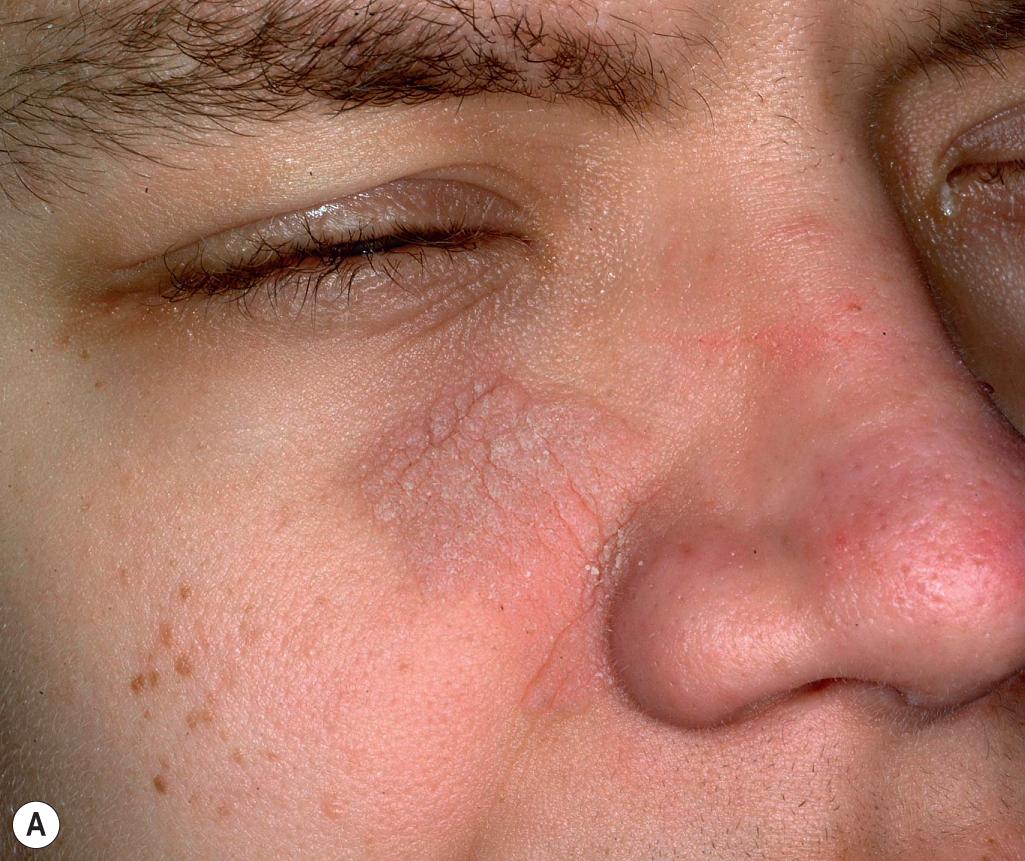 Fig. 6.12, Costello syndrome. Papillomata on the face can be confluent verrucous plaques (A) or small papules (B) and tend to occur on the midface. Note the coarse, curled eyelashes (A) .