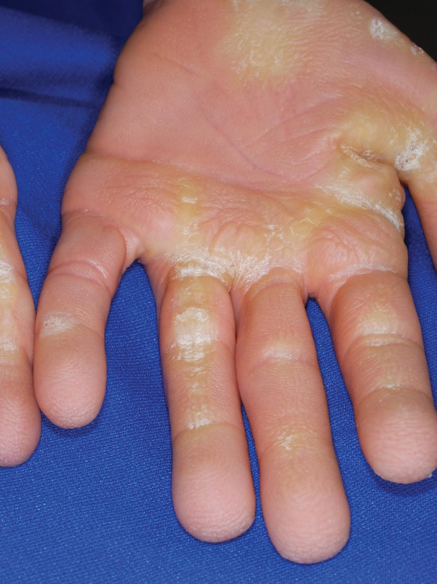 Fig. 6.13, Costello syndrome. Striate keratoderma on the palmar aspect of the fingers is sometimes seen, in addition to keratotic plaques on the palms.
