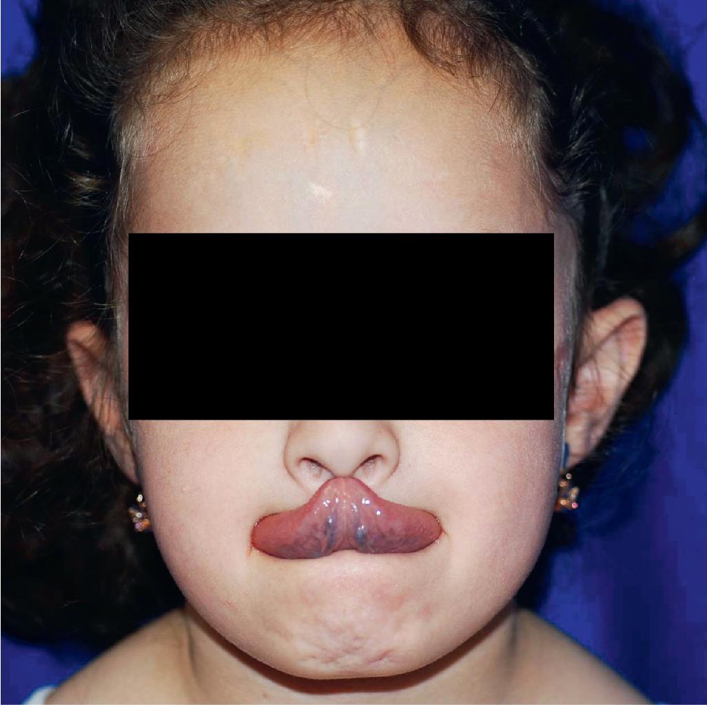 Fig. 6.2, Ehlers–Danlos syndrome (EDS). Gorlin sign is five times more common in EDS than in normal individuals. Note the scars on the forehead.