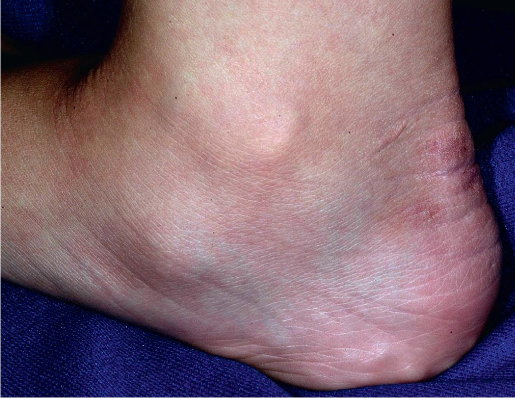 Fig. 6.3, Ehlers–Danlos syndrome. Piezogenic pedal papules are caused by pressure-induced herniation of subcutaneous fat, seen here on the lateral aspect of the heel.