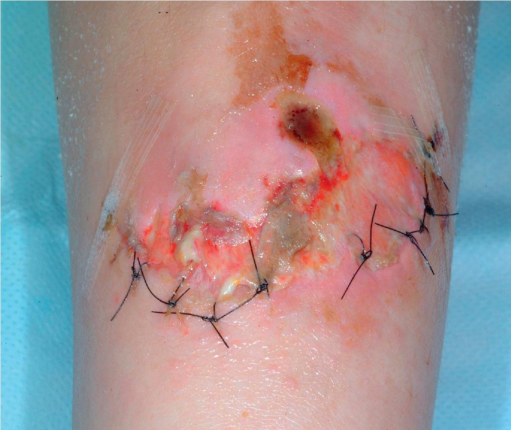 Fig. 6.4, Ehlers–Danlos syndrome. Minor trauma results in a large wound on the shin. The wound dehisced despite placement of several sutures.