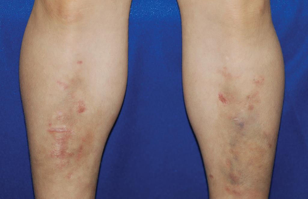 Fig. 6.5, Ehlers–Danlos syndrome. Poor wound healing and persistent discoloration with active ecchymosis of the anterior aspect of the lower extremities of this adolescent girl.