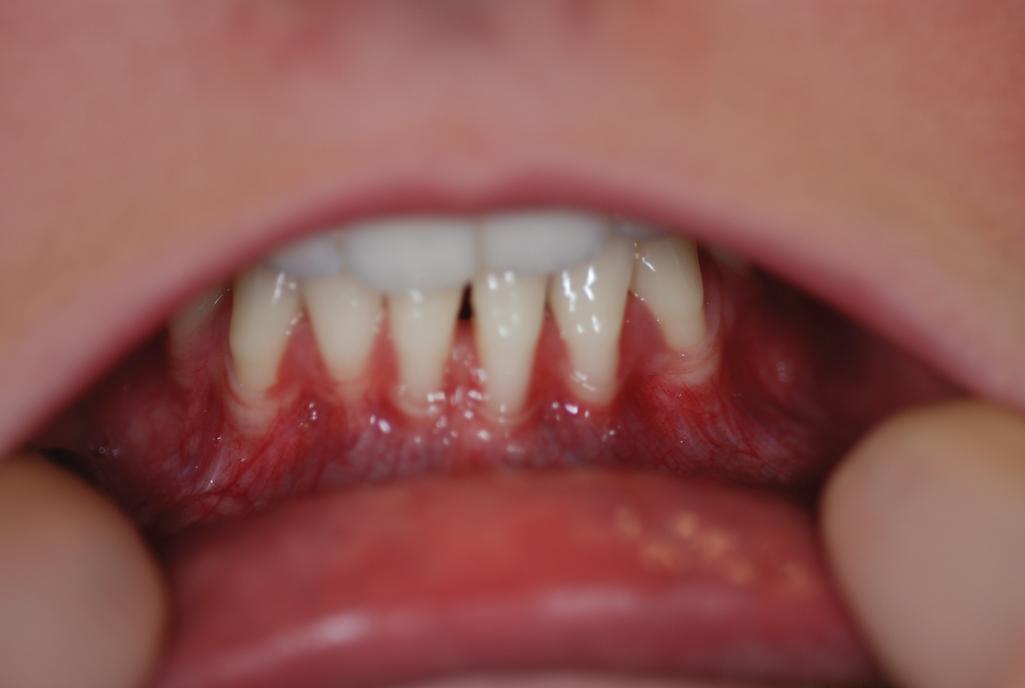 Fig. 6.7, Periodontitis in a girl with periodontal Ehlers–Danlos syndrome.