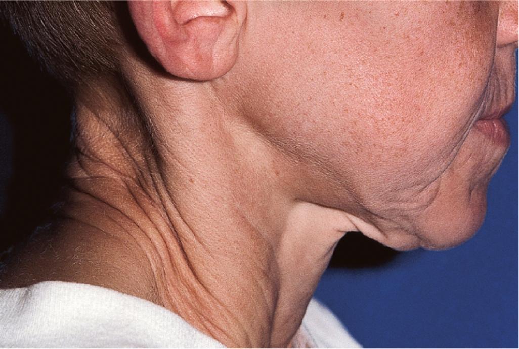 Fig. 6.9, Cutis laxa. Sagging skin in an affected 8-year-old child.