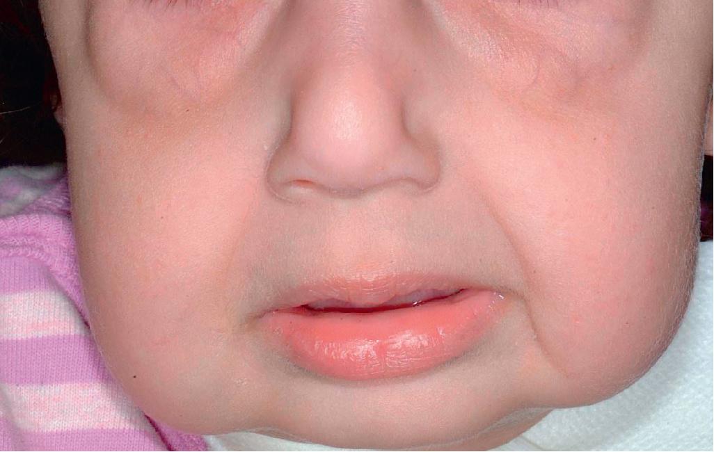 Fig. 6.10, Cutis laxa. This 2-year-old girl with fibulin-4 deficiency shows the sagging infraorbital and cheek skin of cutis laxa.