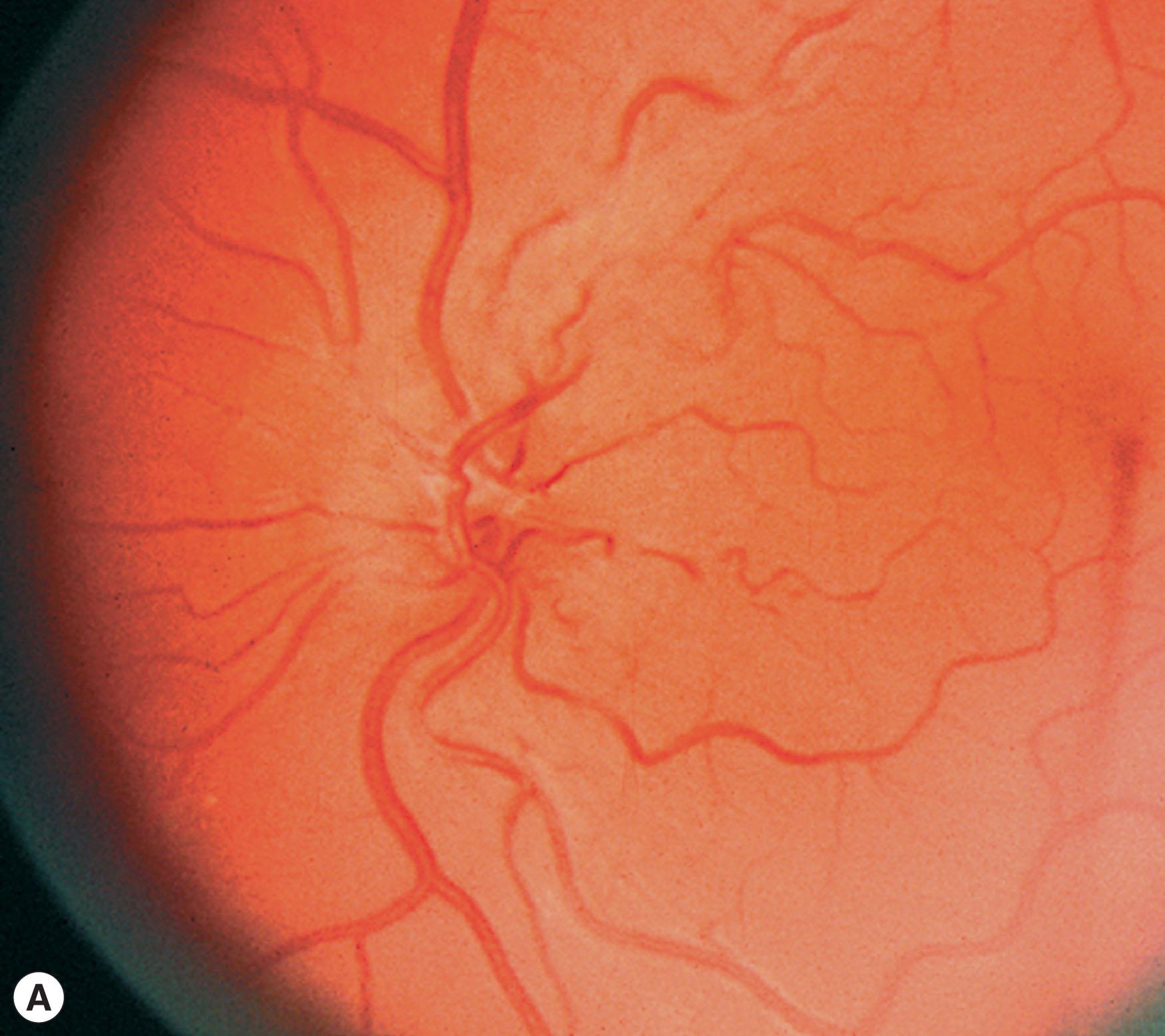 Fig. 54.1, Leber hereditary optic neuropathy. (A) Left fundus at the time of visual loss showing mild hyperemia of the optic disc with peripapillary telangiectasias. (B) Goldmann visual field demonstrating a central scotoma in the left eye. (C) Left optic disc pallor with cupping 5 months after visual loss in a patient with Leber hereditary optic neuropathy.