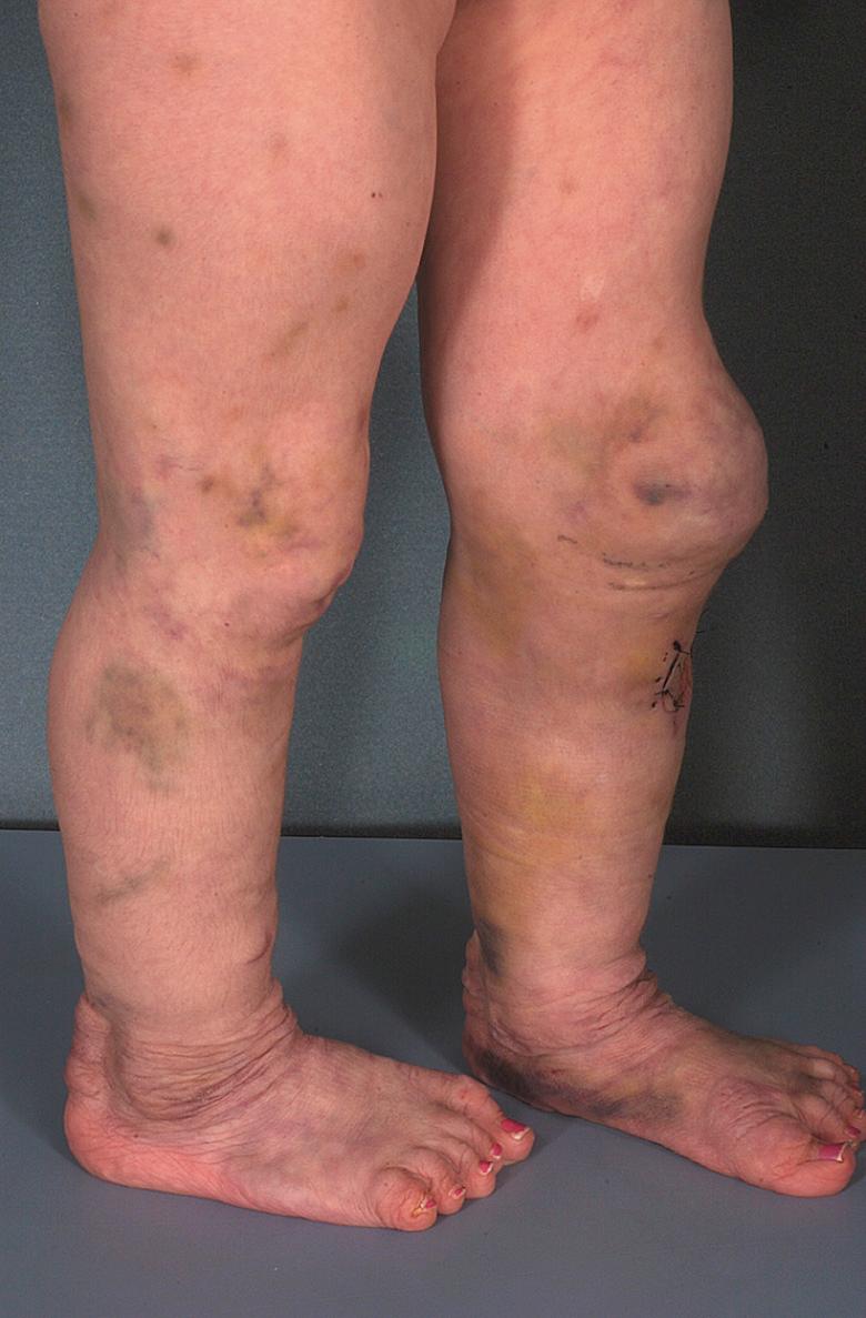 Fig. 97.4, Extensive bruising on the shins in a patient with the dermatosparaxis type of Ehlers–Danlos syndrome (EDS).