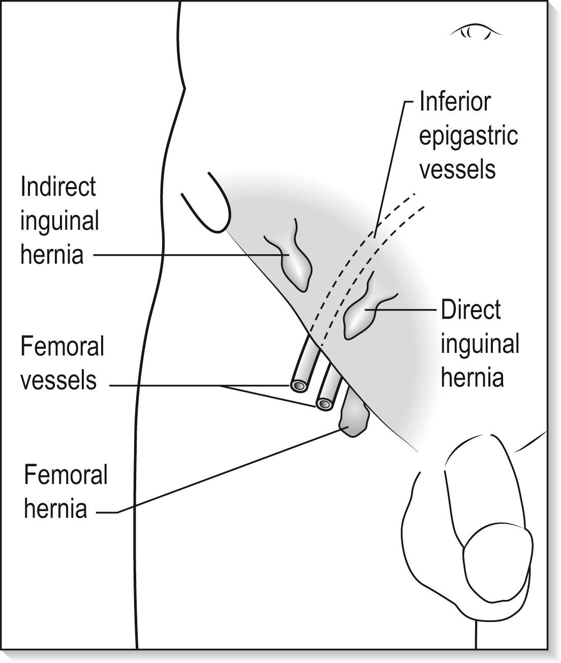 e-Fig. 7.4.1, Common inguinal herniae.