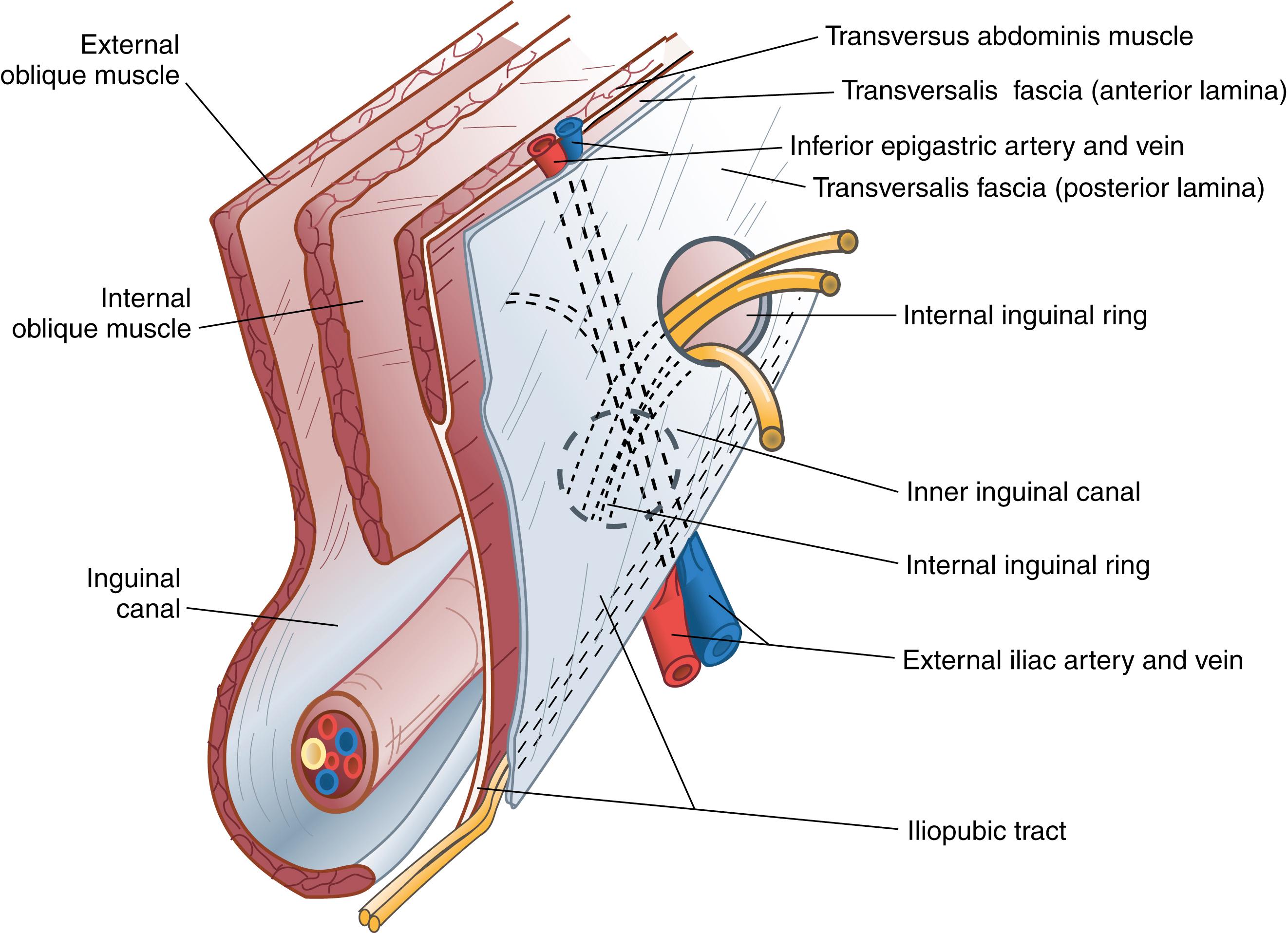 Fig. 45.2, Nyhus’s classic parasagittal diagram of the right midinguinal region illustrating the muscular aponeurotic layers separated into anterior and posterior walls. The posterior laminae of the transversalis fascia have been added, with the inferior epigastric vessels coursing through the abdominal wall medially to the inner inguinal canal.