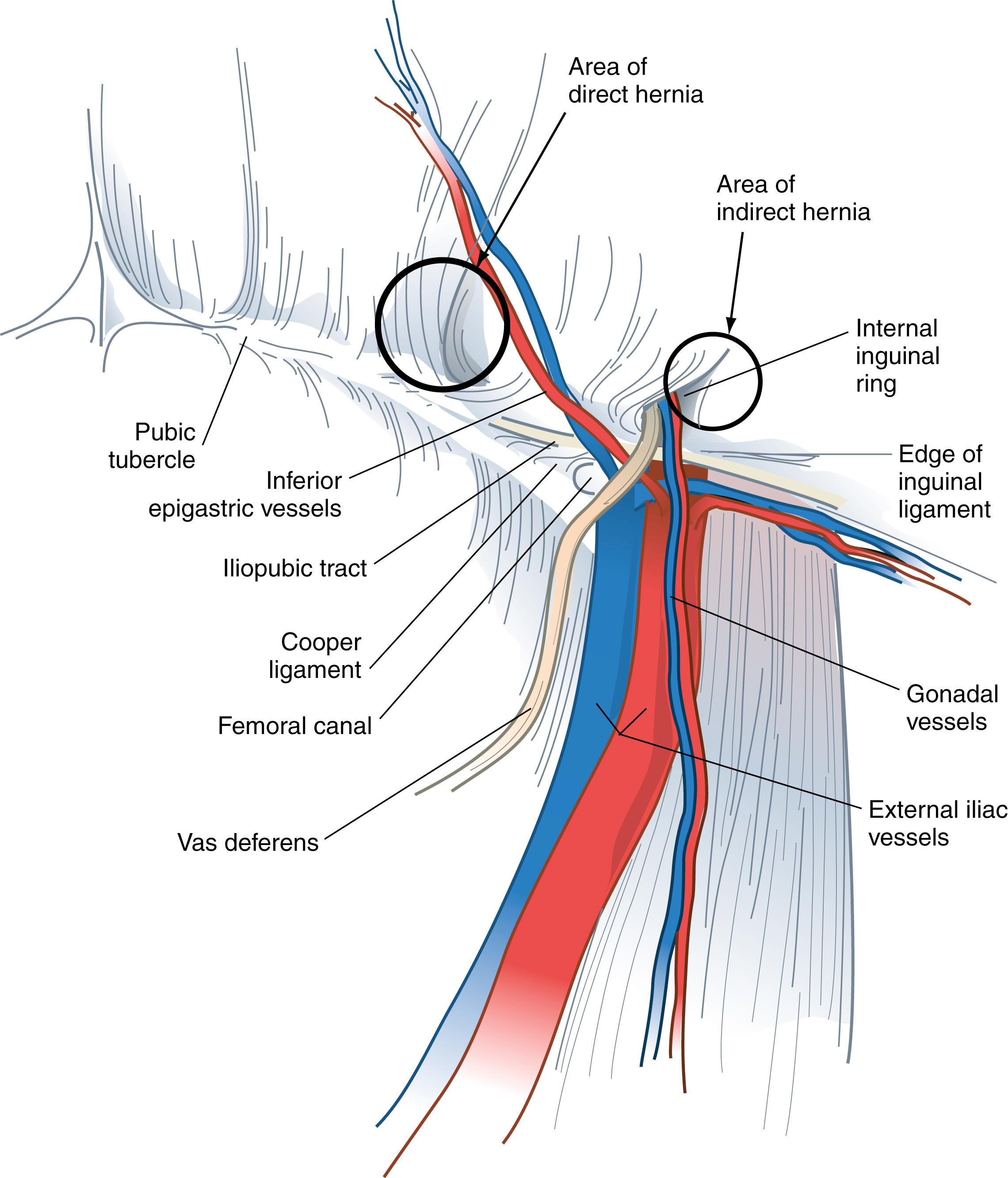 Fig. 45.3, Anatomy of the important preperitoneal structures in the right inguinal space.