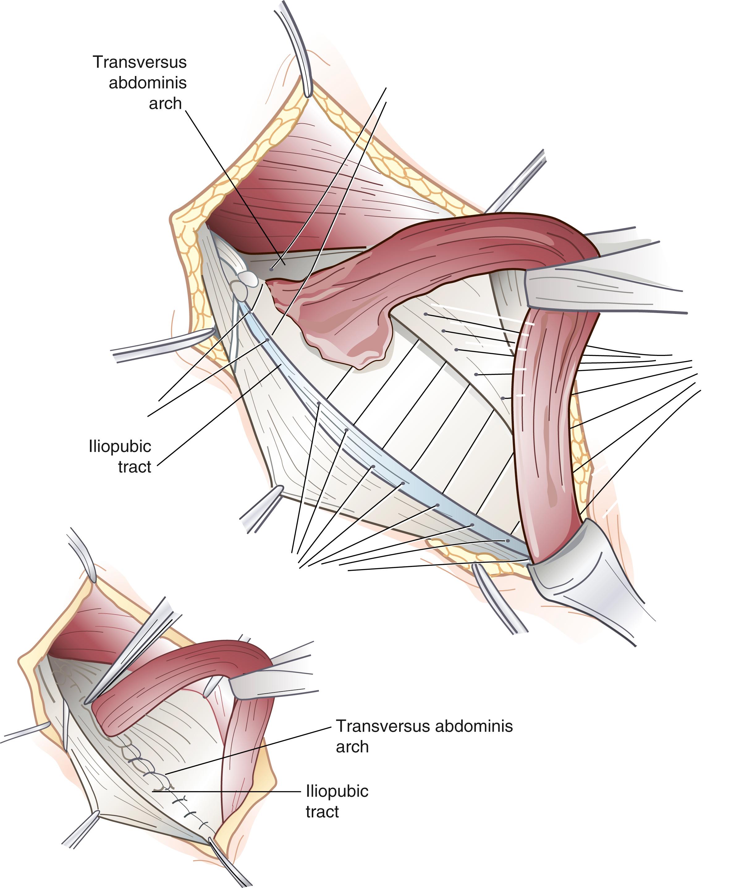 Fig. 45.5, Iliopubic tract repair. Top , Sutures lateral to the cord complete reconstruction of the deep inguinal ring. These sutures encompass the transversus abdominis arch above and the cremaster origin and iliopubic tract below. Bottom , The complete repair is ready for wound closure. The reconstruction of the deep ring should be snug but also loose enough to admit the tip of a hemostat.