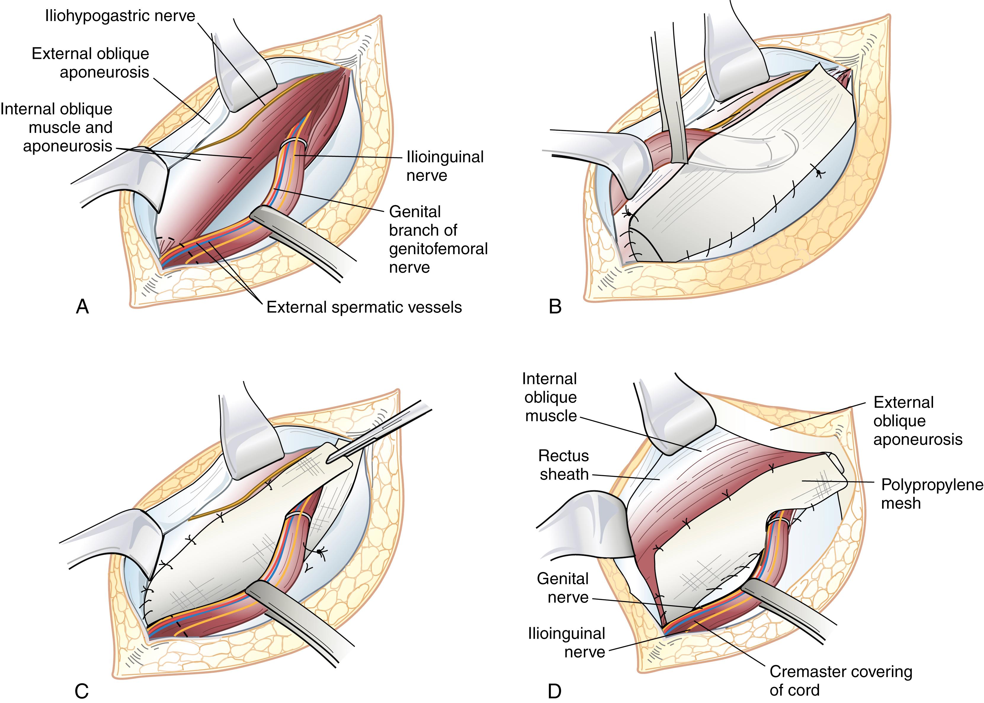 Fig. 45.6, Lichtenstein tension-free hernia repair. (A) This procedure is performed by careful dissection of the inguinal canal. High ligation of an indirect hernia sac is performed, and the spermatic cord structures are retracted inferiorly. The external oblique aponeurosis is separated from the underlying internal oblique muscle high enough to accommodate a 6- to 8-cm-wide mesh patch. Overlap of the internal oblique muscle edge by 2 to 3 cm is necessary. A sheet of polypropylene mesh is fashioned to fit the inguinal canal. A slit is made in the lateral aspect of the mesh, and the spermatic cord is placed between the two tails of the mesh. (B) The spermatic cord is retracted in the cephalad direction. The medial aspect of the mesh overlaps the pubic bone by approximately 2 cm. The mesh is secured to the aponeurotic tissue overlying the pubic tubercle by a running suture of nonabsorbable monofilament material. The suture is continued laterally by suturing the inferior edge of the mesh to the shelving edge of the inguinal ligament to a point just lateral to the internal inguinal ring. (C) A second monofilament suture is placed at the level of the pubic tubercle and continued laterally by suturing the mesh to the internal oblique aponeurosis or muscle approximately 2 cm from the aponeurotic edge. (D) The lower edges of the two tails are sutured to the shelving edge of the inguinal ligament to create a new internal ring made of mesh. The spermatic cord structures are placed within the inguinal canal overlying the mesh. The external oblique aponeurosis is closed over the spermatic cord.