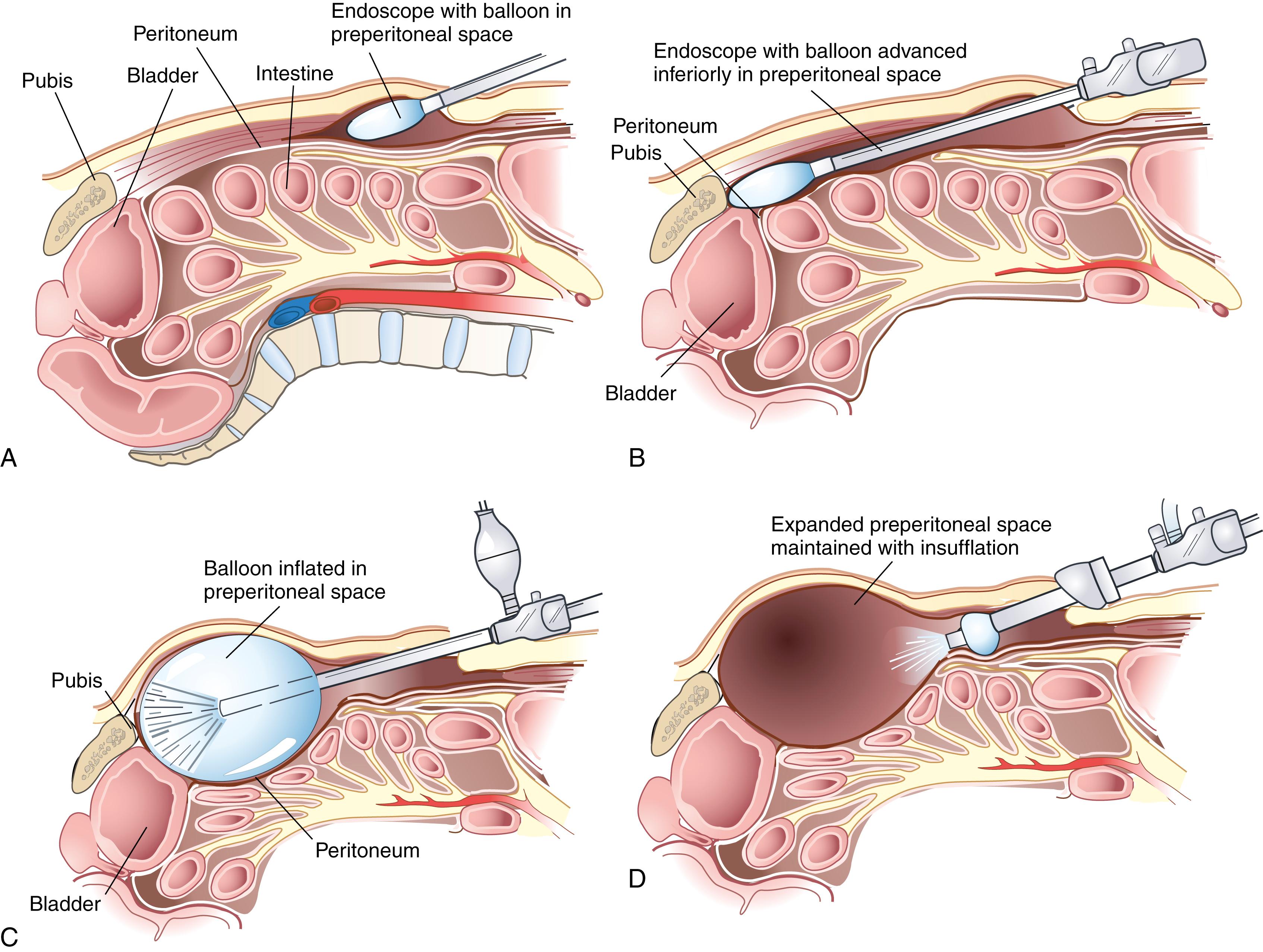 Fig. 45.7, Totally extraperitoneal laparoscopic hernia repair. (A) Access to the posterior rectus sheath is gained in the periumbilical region. A balloon dissector is placed on the anterior surface of the posterior rectus sheath. (B) The balloon dissector is advanced to the posterior surface of the pubis in the preperitoneal space. (C) The balloon is inflated, thereby creating an optical cavity. (D) The optical cavity is insufflated by carbon dioxide, and the posterior surface of the inguinal floor is dissected.