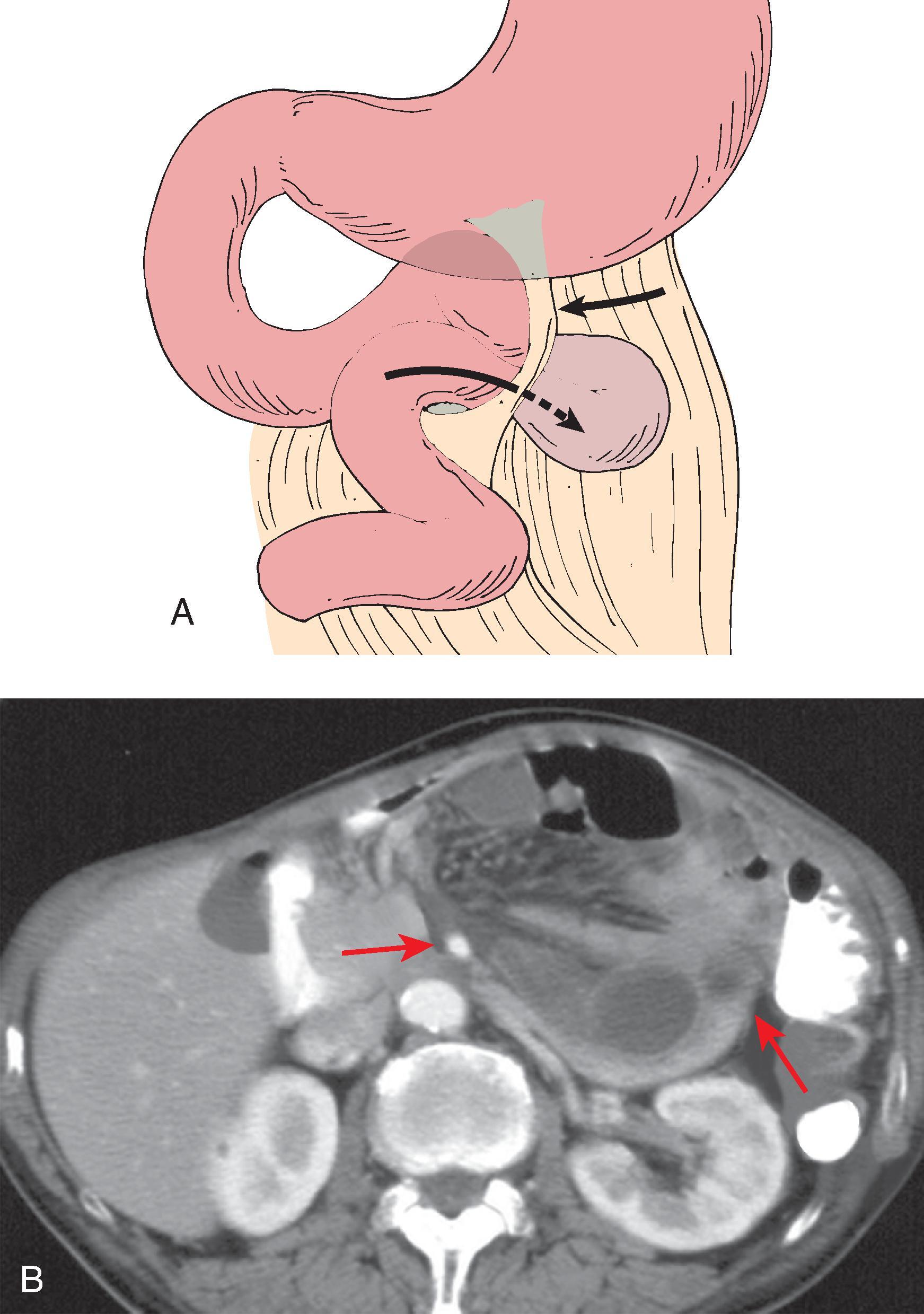 Fig. 67.2, Left paraduodenal hernia.