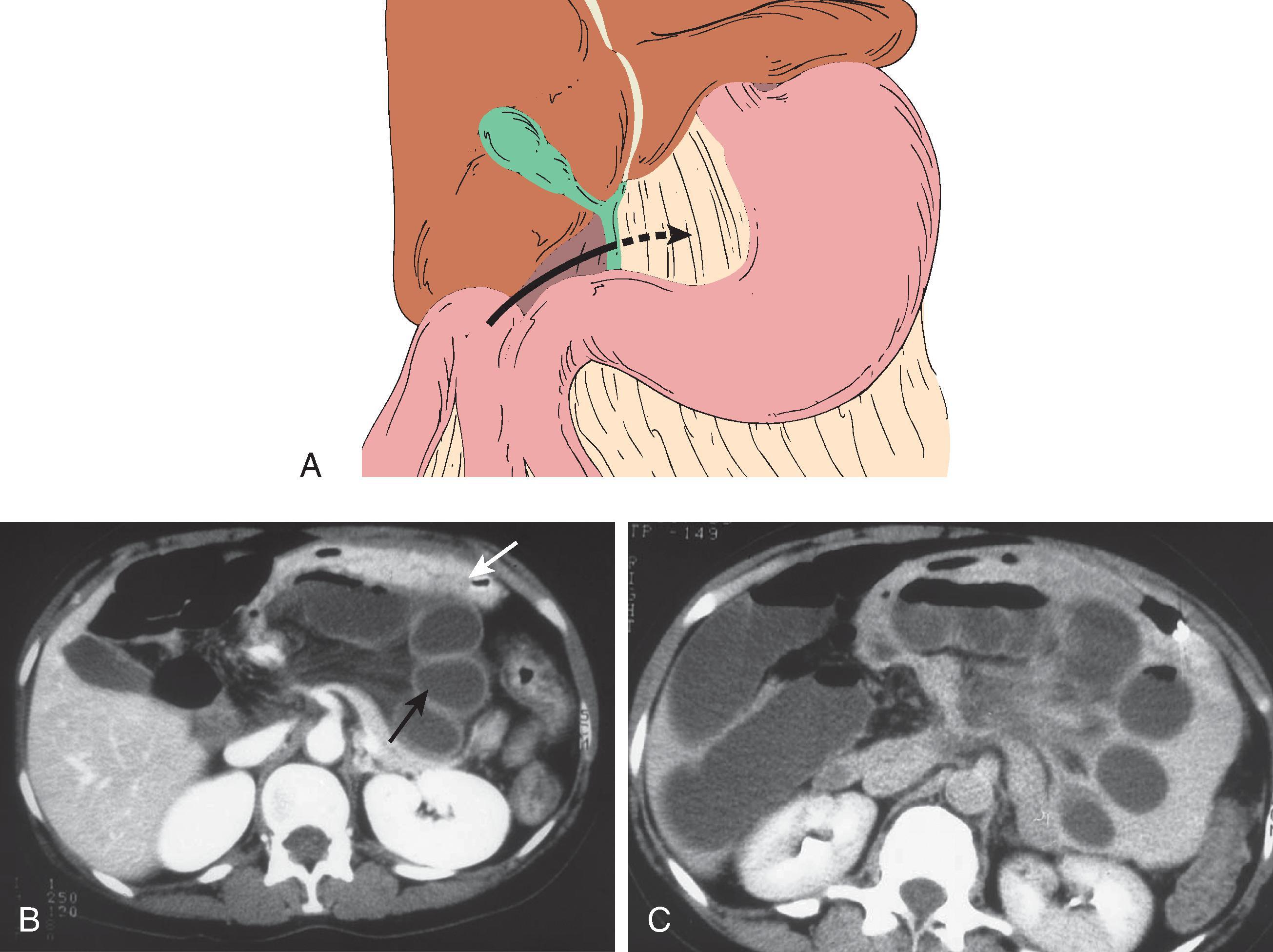 Fig. 67.4, Foramen of Winslow hernia.