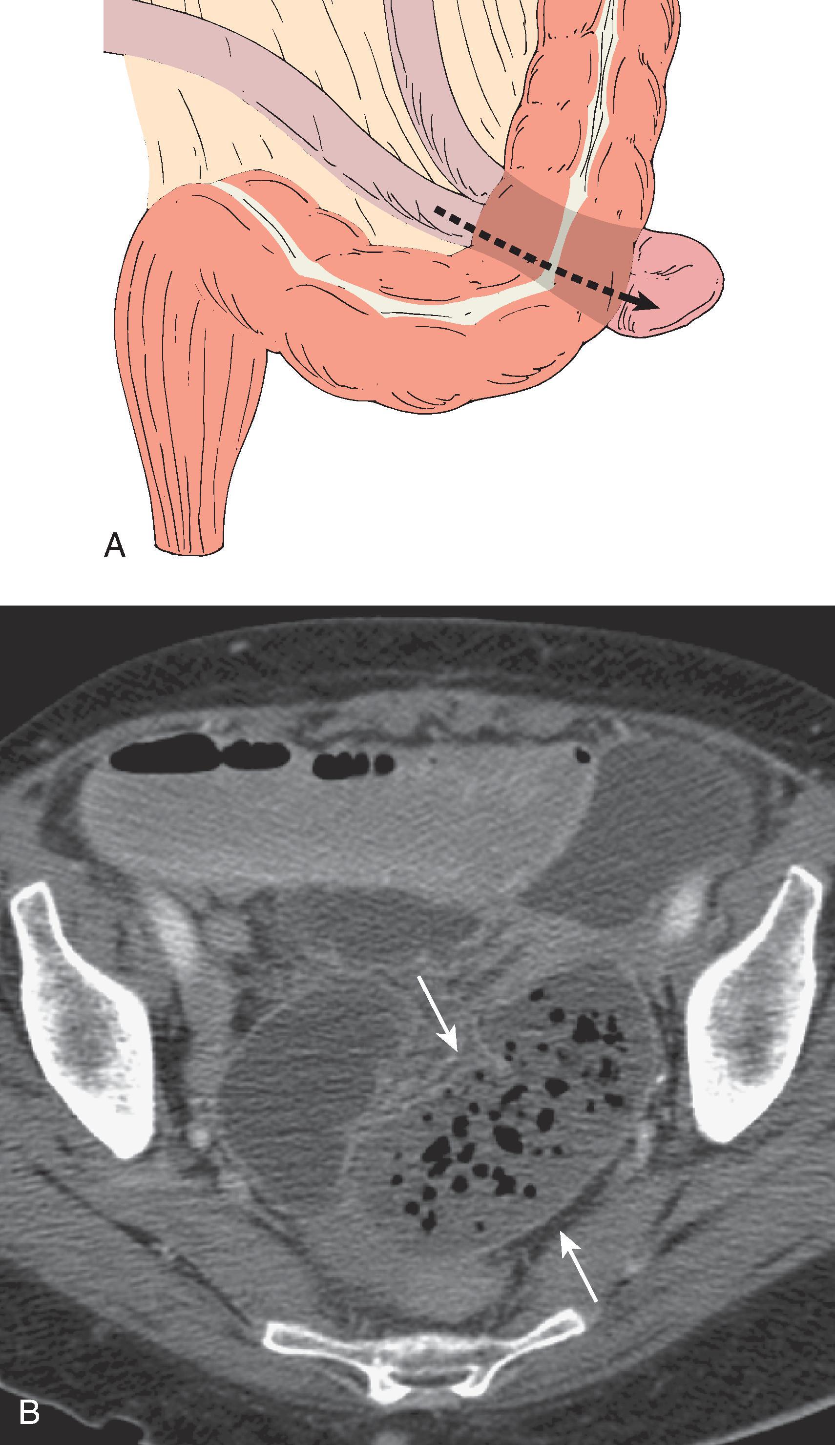 Fig. 67.6, Intersigmoid hernia.